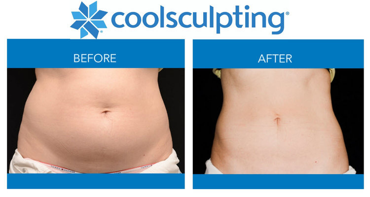 Vancouver Coolsculpting