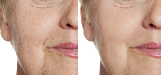 Morpheus8 – RF Microneedling Vancouver