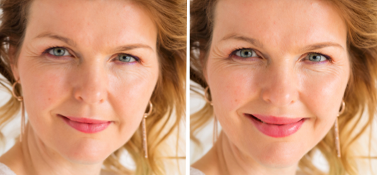 dermal fillers Vancouver, lip fillers Vancouver