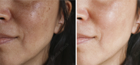 skin care Vancouver